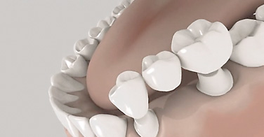 animation 3D de la pose d'un bridge