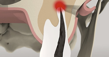 animation 3D sur la résection apicale par voie rétrograde