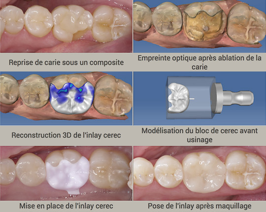 modélisation de plusieurs traitements réalisés avec la méthode CEREC au cabinet des Halles à Neuchatel