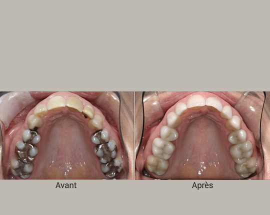 différence avant et après d'un traitement dentaire avec le CEREC sur un patient