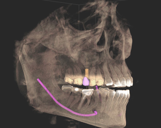 scan de la dentition d'un patient du Dr. Veuve, dentiste neuchatel